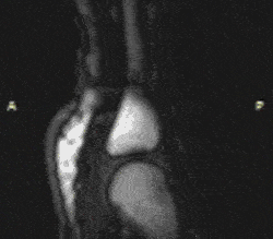 MRI showing joint cracking